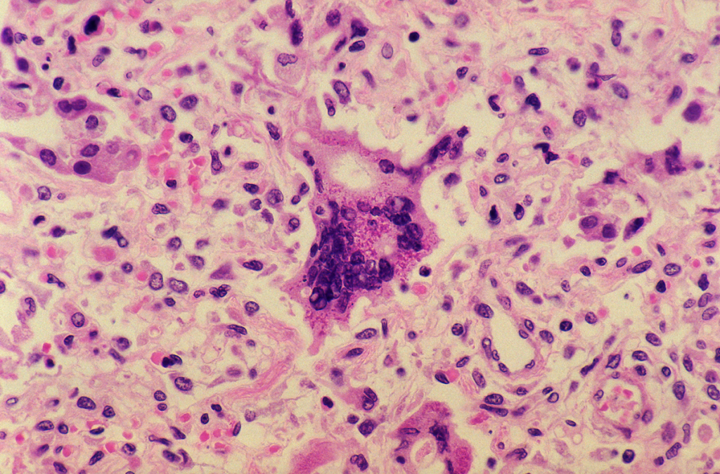 measles