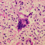 measles