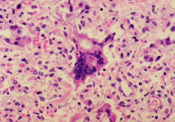 measles